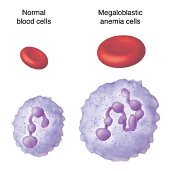 Megaloblastic Anemia: An Overview, Symptoms, Causes and Treatment